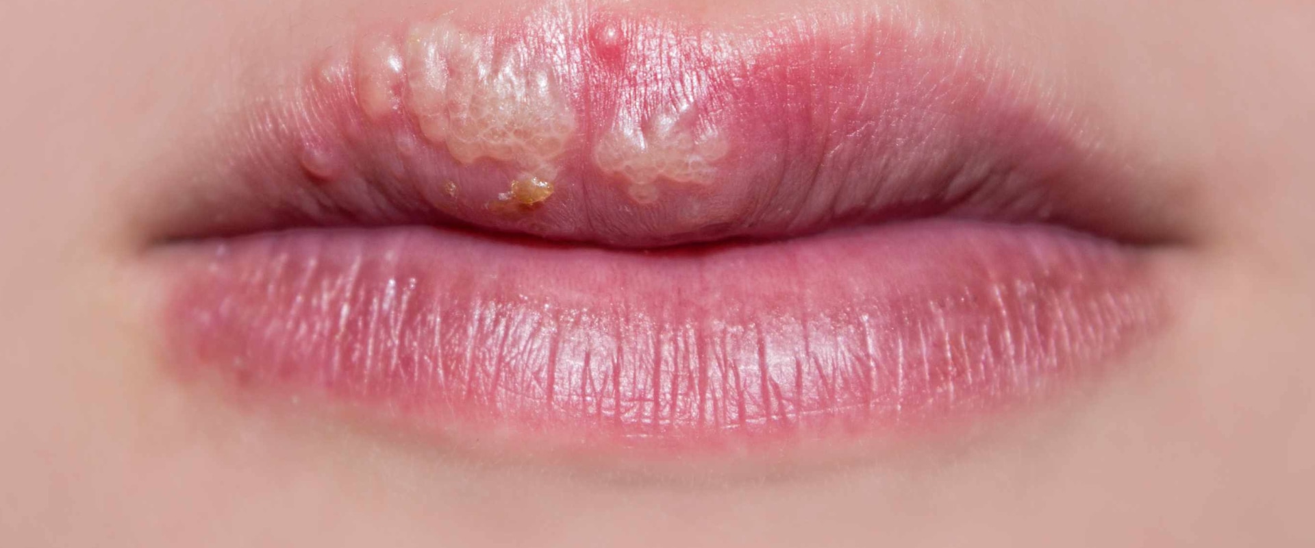 Pain Relievers: Exploring Treatment Options for In Mouth Herpes