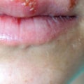 Herpes Simplex Virus Type 2: Causes, Symptoms, and Treatment