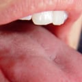 Tingling Sensation in the Mouth: An Overview