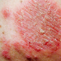 Understanding Itchy or Burning Rashes on the Skin
