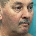 Swollen Lymph Nodes: A Comprehensive Overview