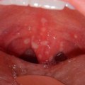Painful Sores or Blisters in the Mouth - An Overview