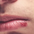 Essential Oils for In Mouth Herpes: An Overview