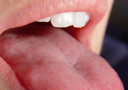Tingling Sensation in the Mouth: An Overview