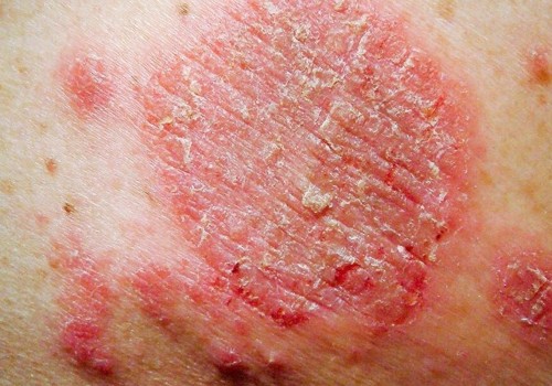 Understanding Itchy or Burning Rashes on the Skin