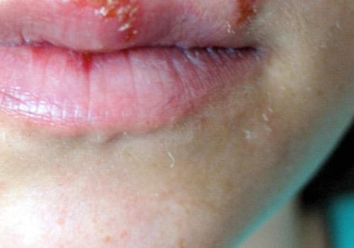 Herpes Simplex Virus Type 1 – Causes, Symptoms, Treatment