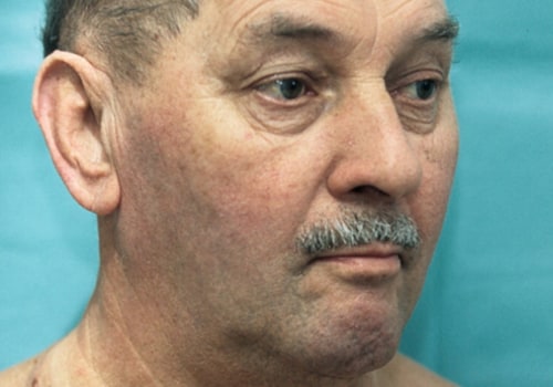 Swollen Lymph Nodes: A Comprehensive Overview