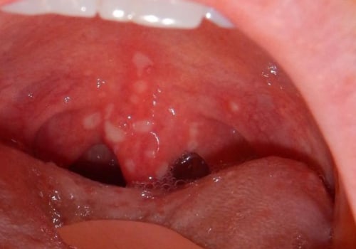 Painful Sores or Blisters in the Mouth - An Overview