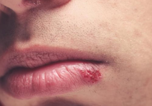 Essential Oils for In Mouth Herpes: An Overview